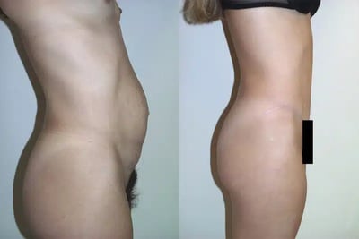 Side view tummy tuck before and after showing abdominal tightening