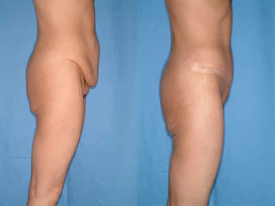 Lower body contour after tummy tuck showing smoother abdomen and thighs