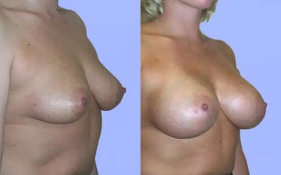 Breast Augmentation before and after photo by American Institute For Plastic Surgery in Plano, TX