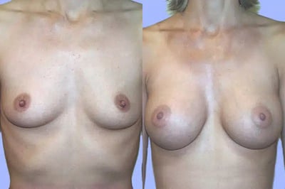 Breast Augmentation before and after photo by American Institute For Plastic Surgery in Plano, TX