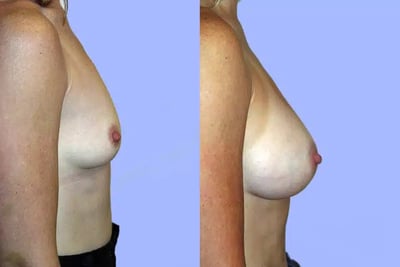 Breast Augmentation before and after photo by American Institute For Plastic Surgery in Plano, TX