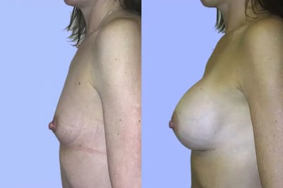 Breast Augmentation before and after photo by American Institute For Plastic Surgery in Plano, TX