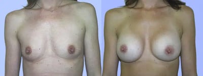 Breast Augmentation Before and After Photo in Plano, TX Breast augmentation before and after results