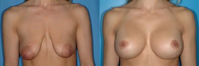 Breast Implant Surgery Results Breast augmentation before and after results