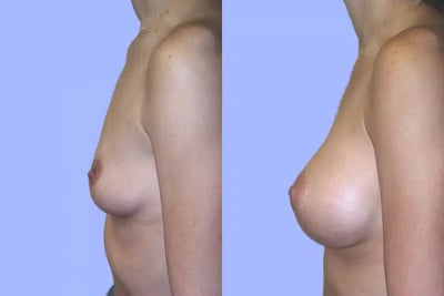 Breast Augmentation before and after photo by American Institute For Plastic Surgery in Plano, TX