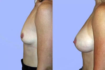Breast Augmentation before and after photo by American Institute For Plastic Surgery in Plano, TX