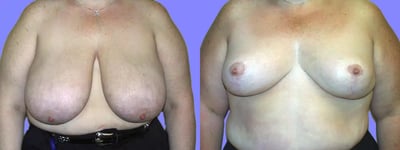 Breast Reduction before and after photo by American Institute For Plastic Surgery in Plano, TX