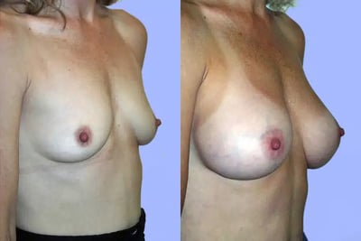 Breast Surgery before and after photo by American Institute For Plastic Surgery in Plano, TX Breast Surgery before and after photo by American Institute For Plastic Surgery in Plano, TX