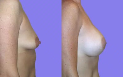 Breast Surgery before and after photo by American Institute For Plastic Surgery in Plano, TX Breast Surgery before and after photo by American Institute For Plastic Surgery in Plano, TX