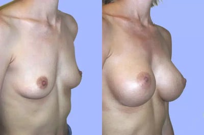 Breast Surgery before and after photo by American Institute For Plastic Surgery in Plano, TX Breast Surgery before and after photo by American Institute For Plastic Surgery in Plano, TX