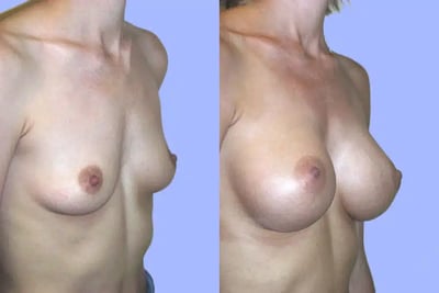 Breast Surgery before and after photo by American Institute For Plastic Surgery in Plano, TX Breast Surgery before and after photo by American Institute For Plastic Surgery in Plano, TX