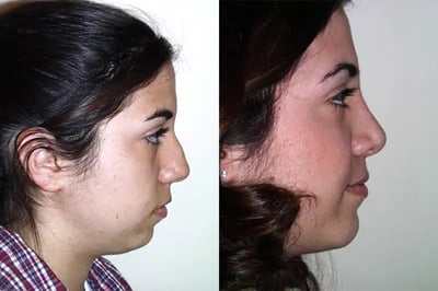 Chin Implant before and after photo by American Institute For Plastic Surgery in Plano, TX