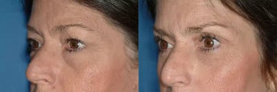 Upper Eyelid Surgery Results Eyelid surgery before and after comparison photo