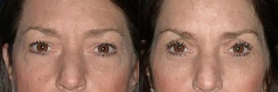 Lower Blepharoplasty Before and After Photo Lower blepharoplasty before and after results