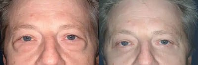 Blepharoplasty before and after photo by American Institute For Plastic Surgery in Plano, TX