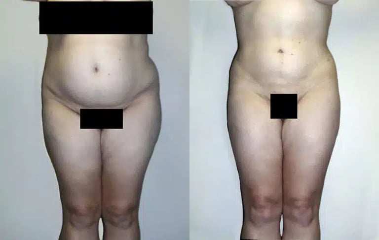 Liposuction before and after photo by American Institute For Plastic Surgery in Plano, TX Liposuction before and after photo by American Institute For Plastic Surgery in Plano, TX