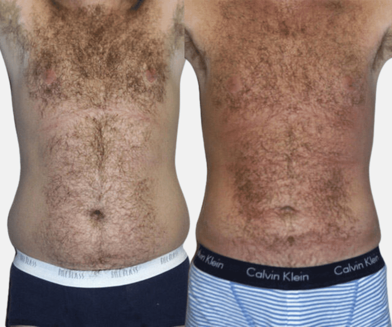 liposuction before and after results liposuction before and after results