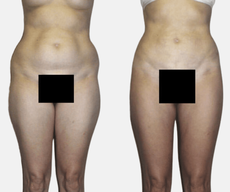 liposuction before and after results liposuction before and after results